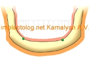 Имплантация зубов и форма челюсти при длительном ношении съемного протеза (отмечается  атофия костной ткани )